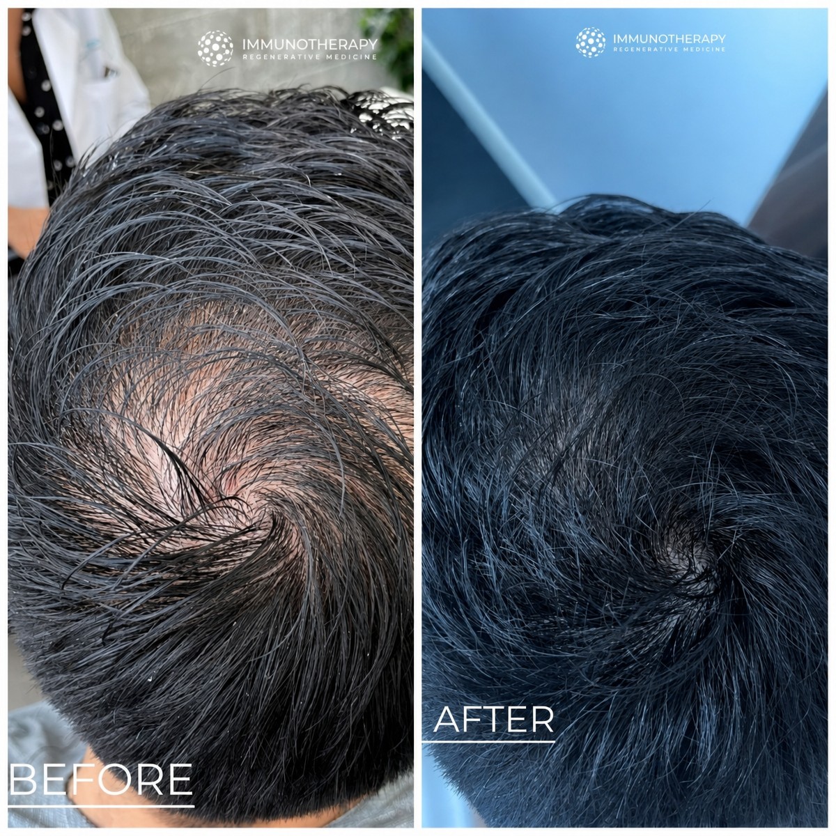 Résultats avant et après greffe de cheveux chez Immunotherapy Regenerative Medicine, densité accrue