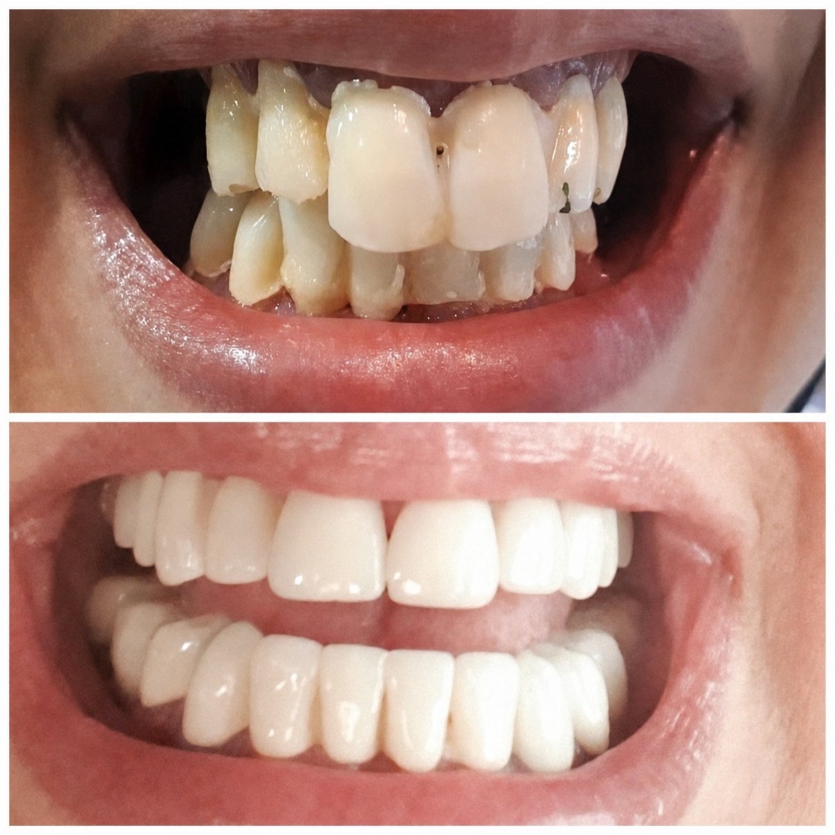 Before and after veneers result at Hospitadent Dental Group - İstanbul Mecidiyeköy Clinic