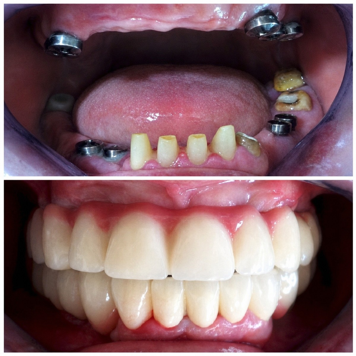 Результаты до и после установки импланта с коронкой в Hospitadent Dental Group - Стамбул Меджидиекёй