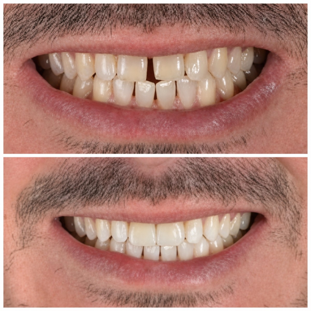 Результат до и после установки коронок в Hospitadent Dental Group - İstanbul Mecidiyeköy Clinic