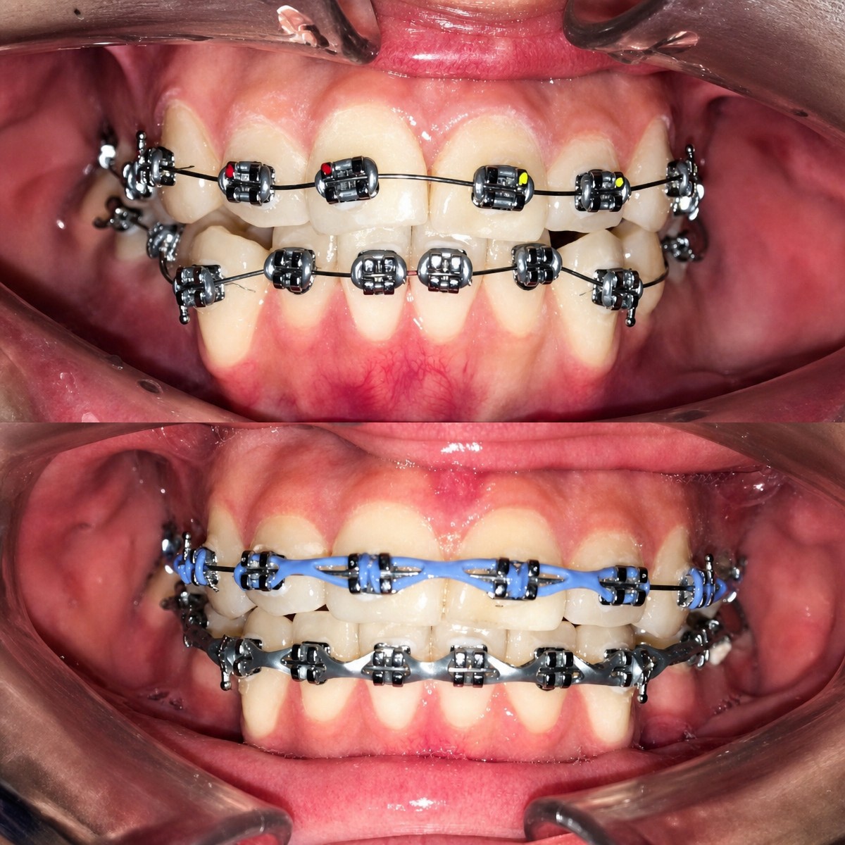 Antes y después del tratamiento de ortodoncia en Deezy Dental Home, mejora visible en alineación dental