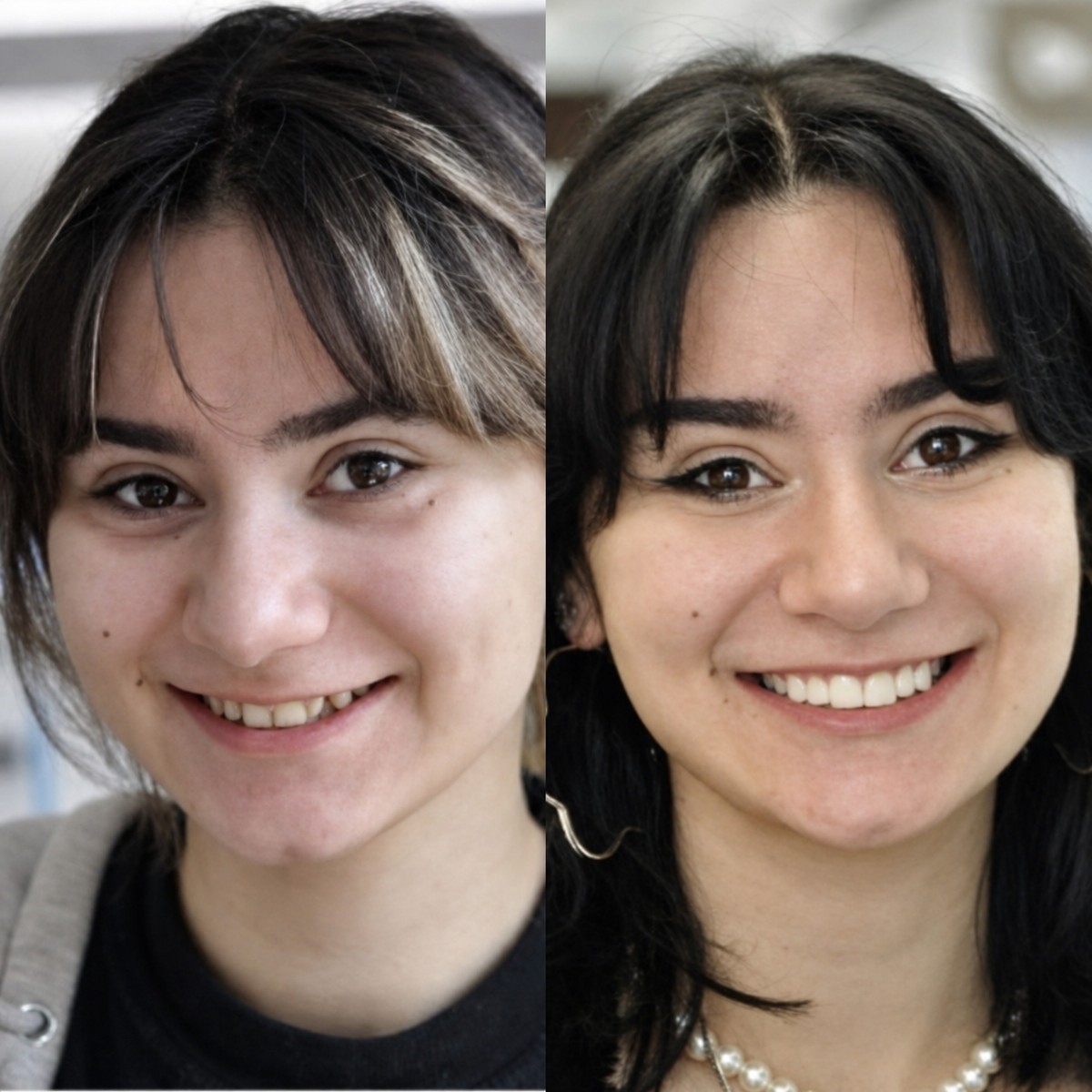 Before and after zirconia crown results at DentaPoint Dental Clinics, smile transformation