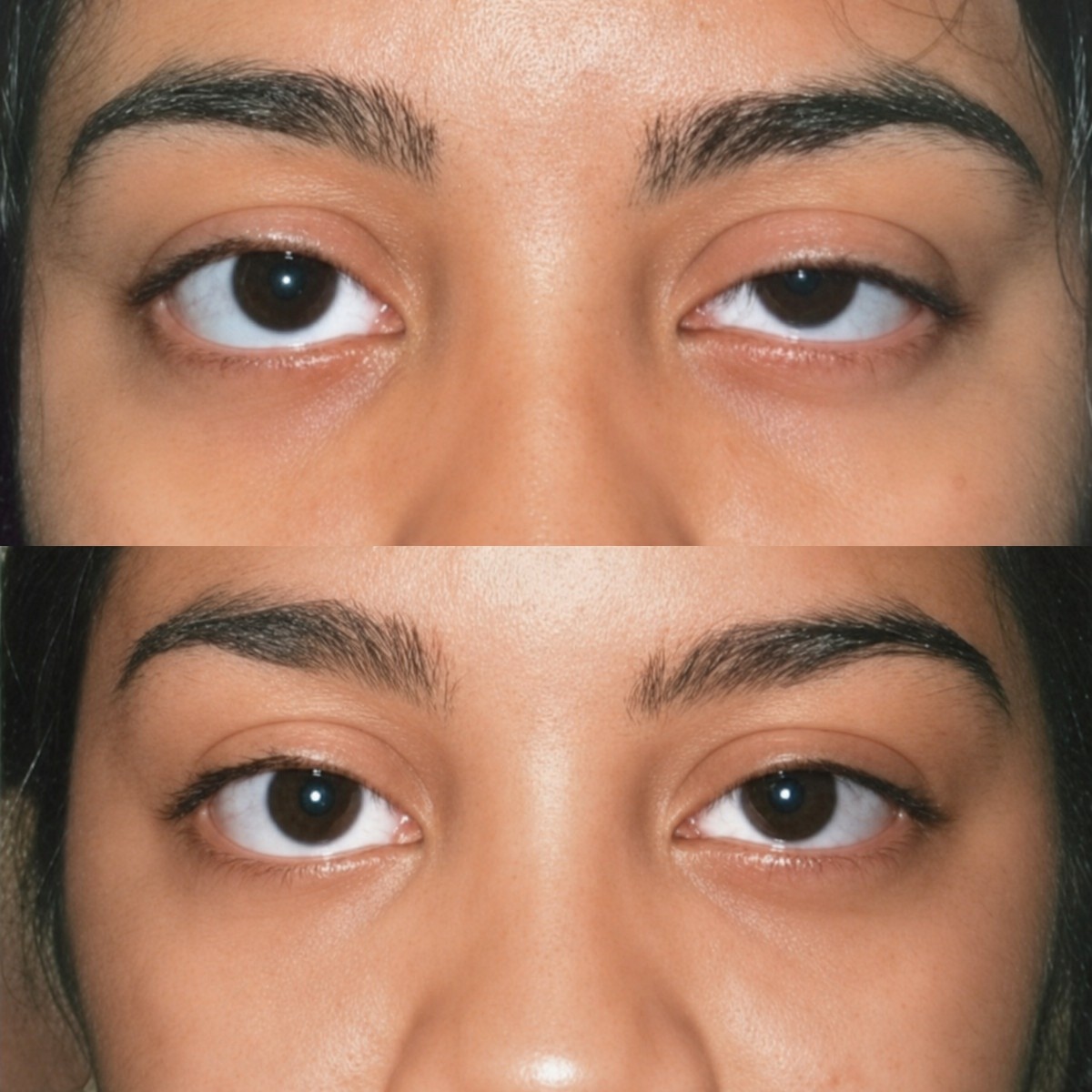 Before and after upper eyelid surgery results at ID Clinic Bangkok, improved eyelid symmetry