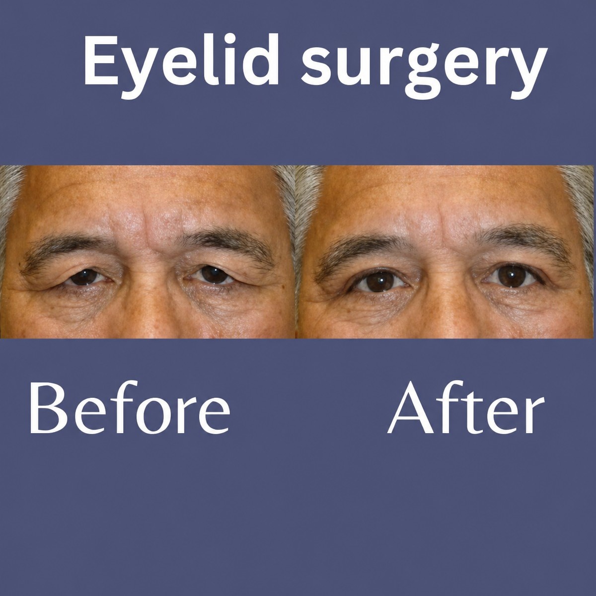 Before and after upper and lower eyelid surgery results at ID Clinic Bangkok
