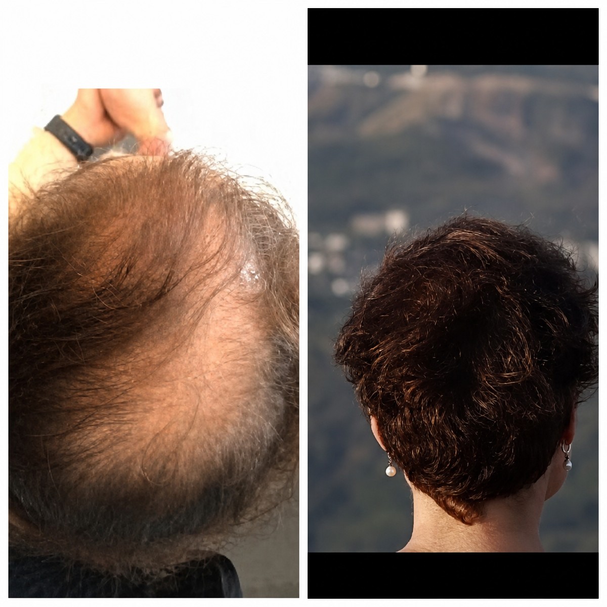Resultados de trasplante capilar femenino antes y después en Adem and Havva Medical Center, cabello más denso