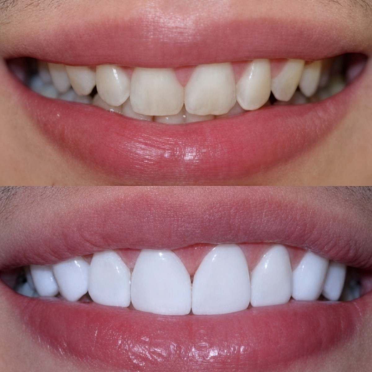 قبل وبعد الفينير في Deezy Dental Home – تحول الابتسامة ونتيجة أسنان أكثر بياضًا
