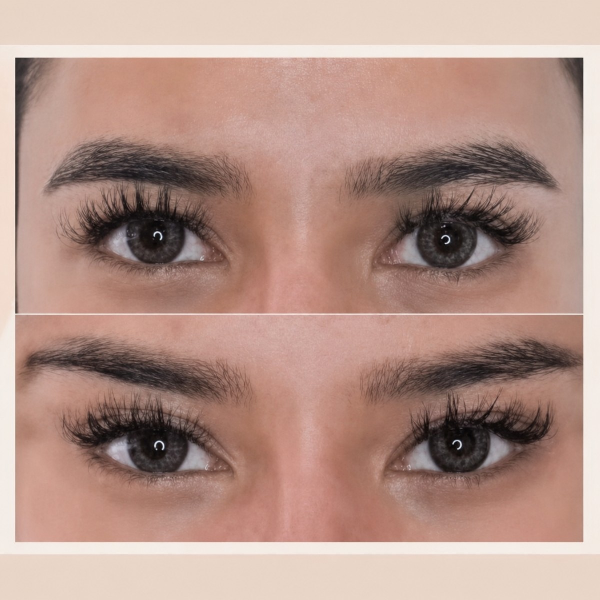 Before and after Fox Eye Lift results at ID Clinic Bangkok, lifted outer eye corners