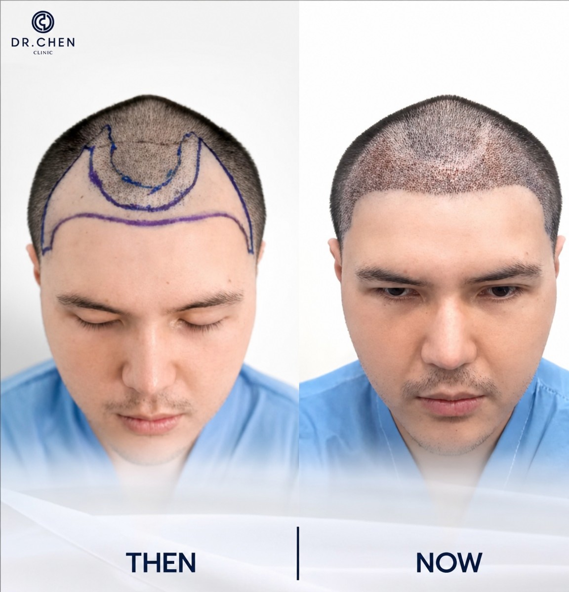 Resultados de trasplante capilar antes y después en Dr. Chen Clinic, restauración capilar