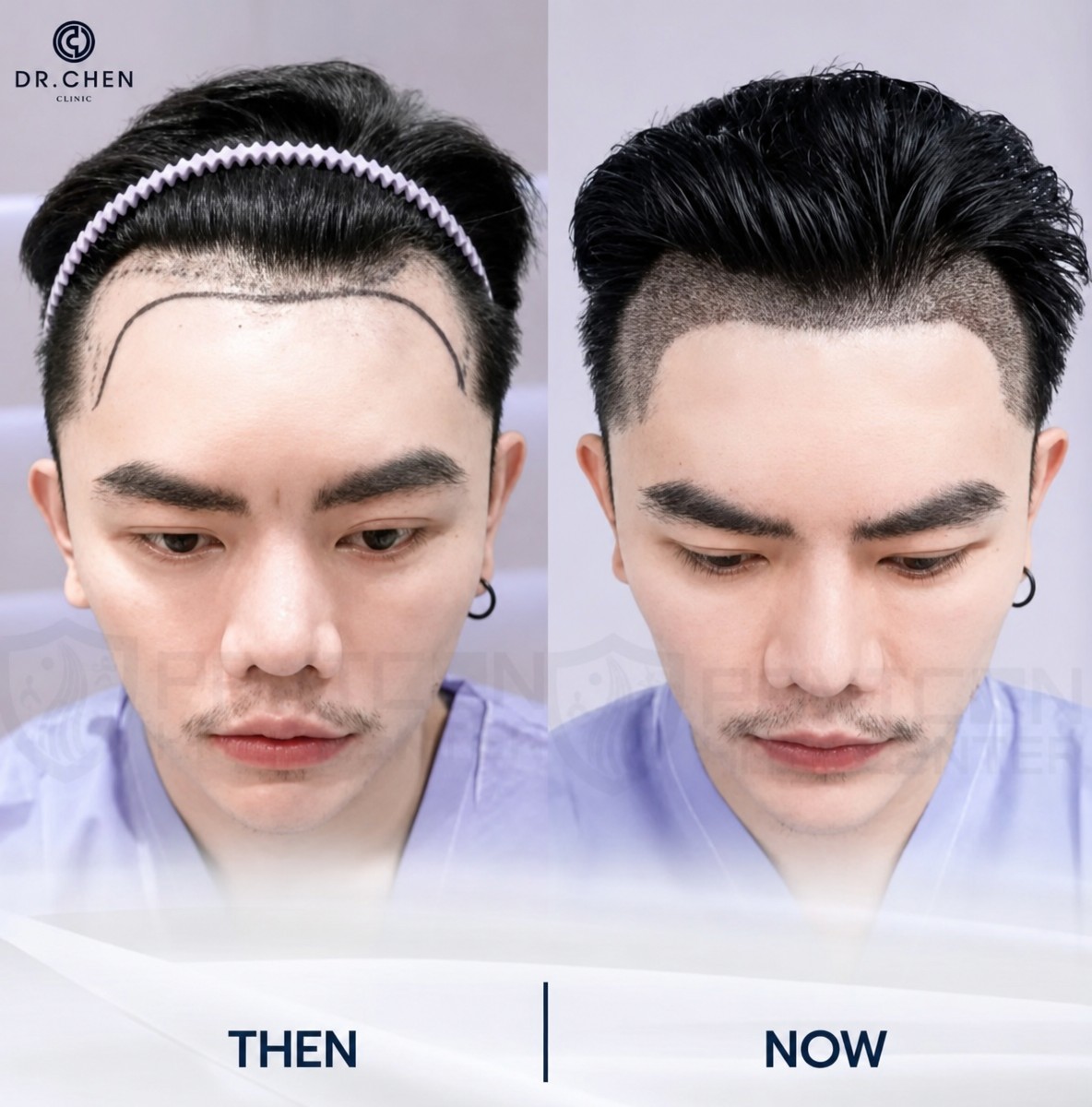 Before and after hair transplant results at Dr. Chen Clinic, improved hairline restoration