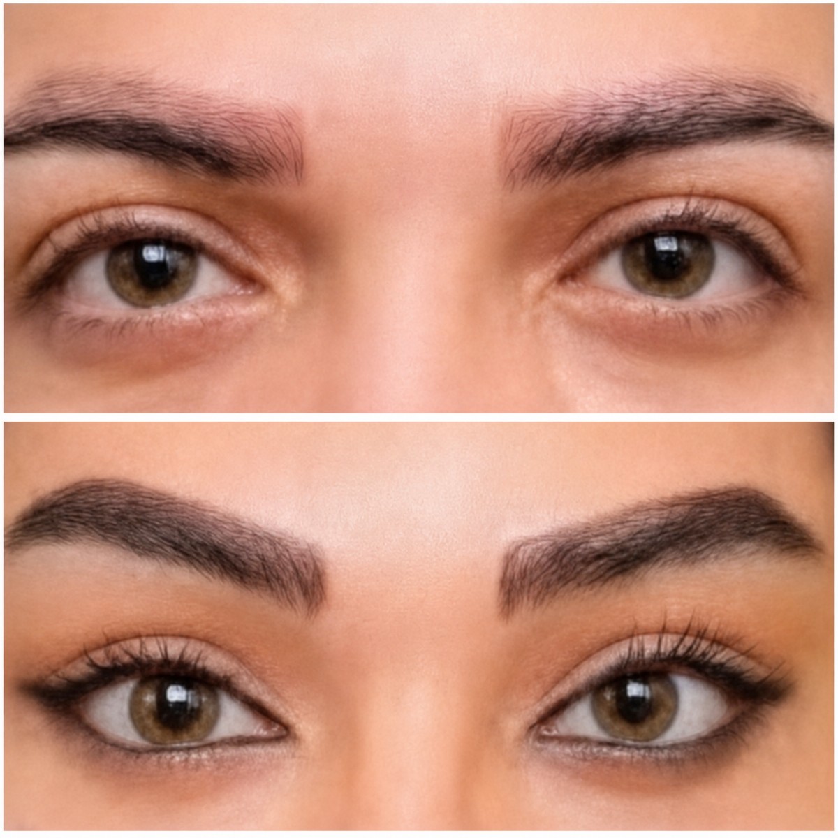 Before and after Fox Eye Lift results at ID Clinic Bangkok, enhanced eye shape and brow lift