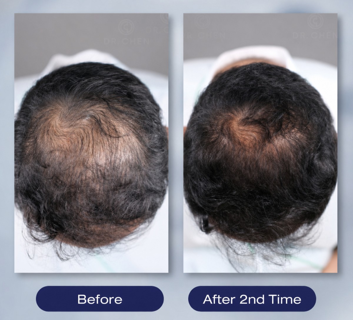 Before and after PRP hair loss treatment results at Dr. Chen Clinic, improved hair density