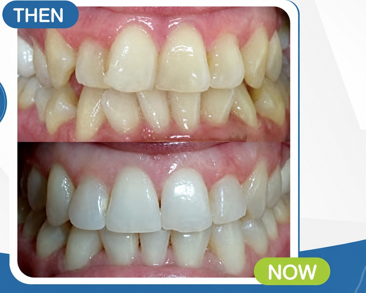 Before and after Damon braces results at Deezy Dental Home – improved teeth alignment