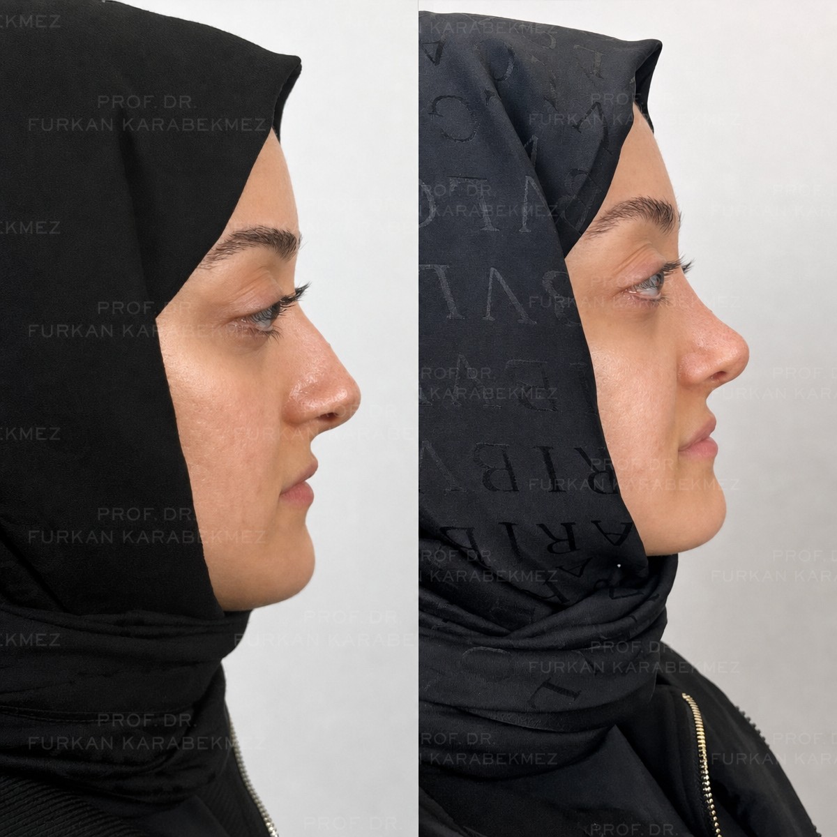 نتائج عملية تجميل الأنف قبل وبعد في عيادة البروفيسور فوركان كارابكمز للجراحة التجميلية
