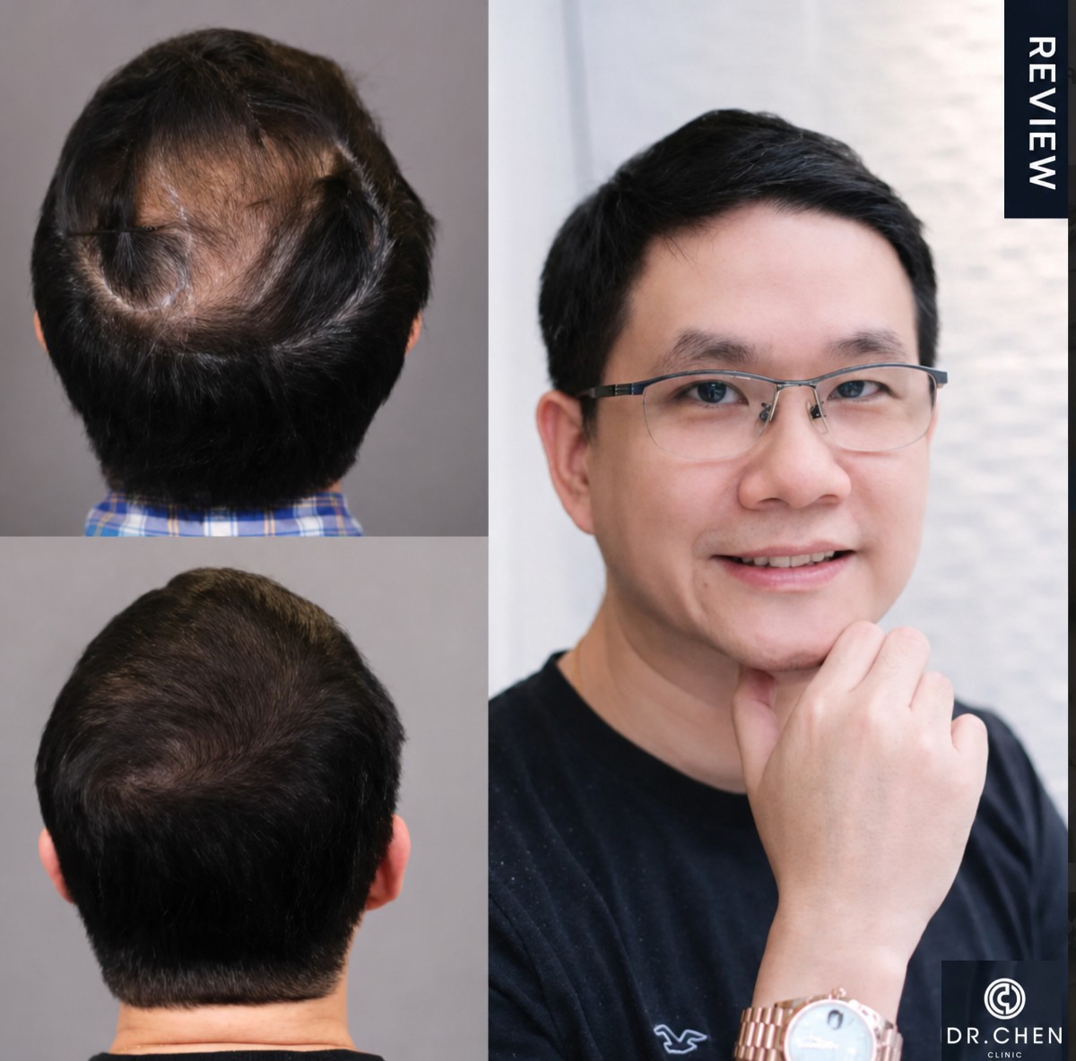 Before and after hair transplant results at Dr. Chen Clinic – restored hair density in male patient