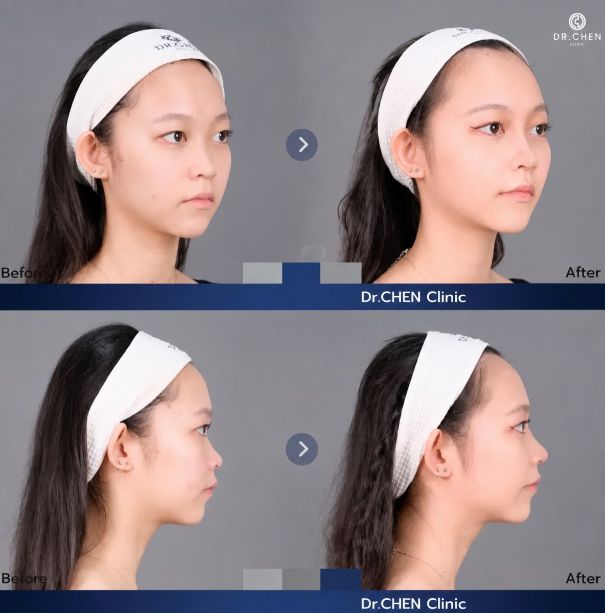 نتائج تصحيح الأنف غير الجراحي قبل وبعد في عيادة Dr. Chen، تحسين شكل الأنف
