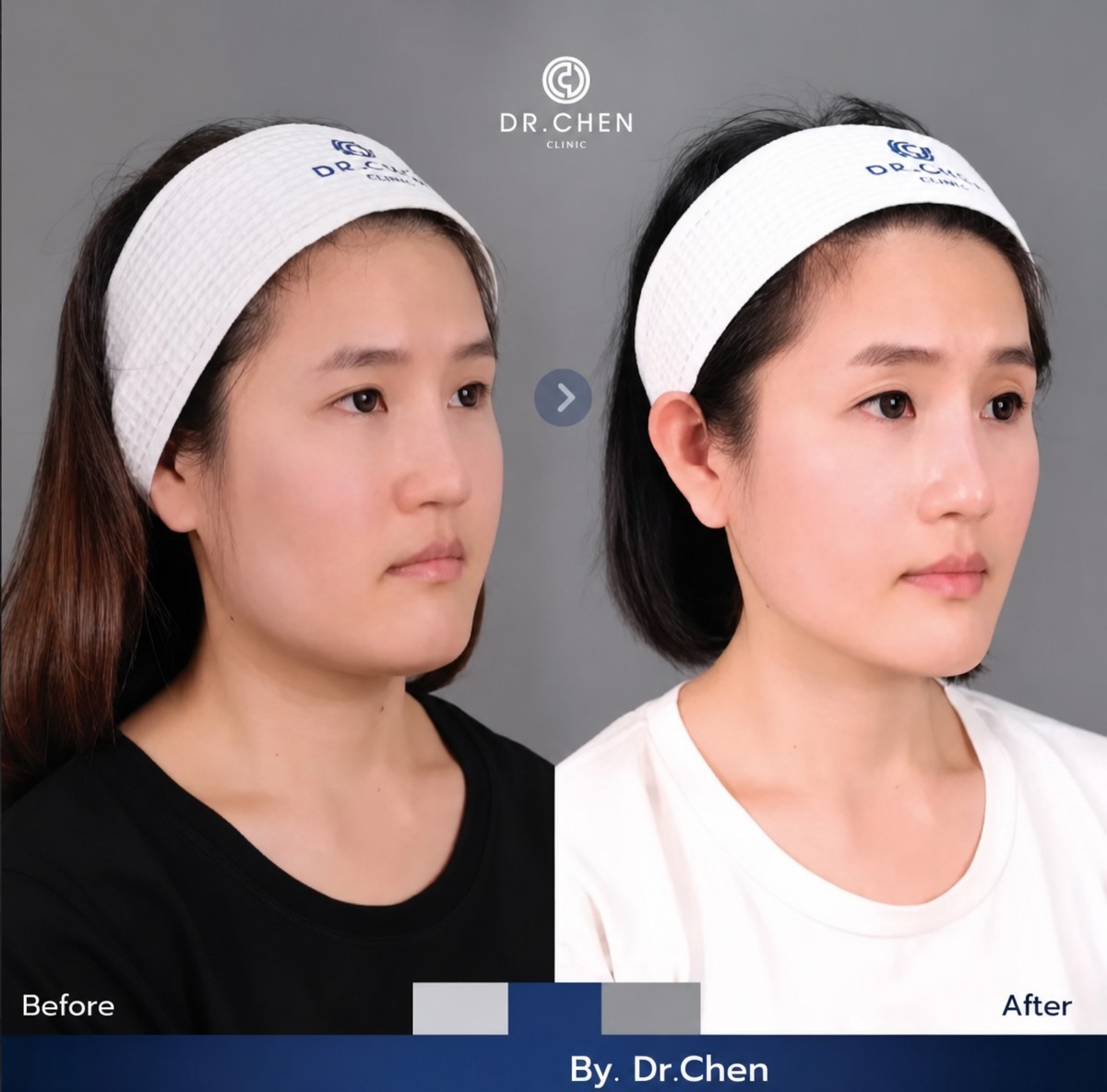 Before and after hyaluronic acid threads lifting result at Dr. Chen Clinic, facial contouring