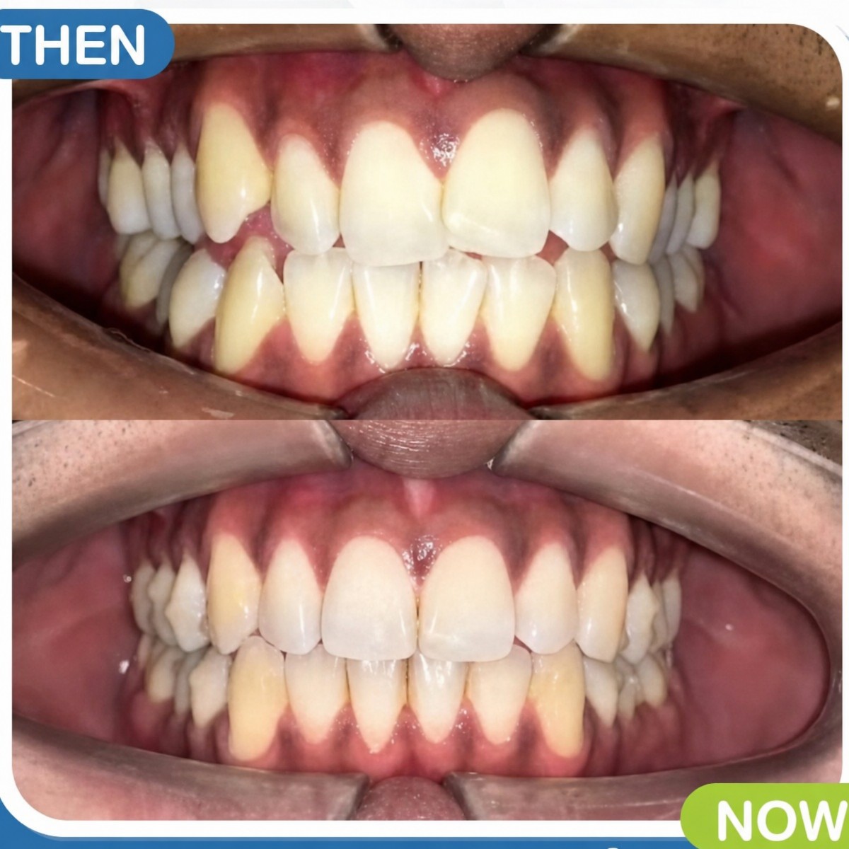 نتائج قبل وبعد تقويم Invisalign في Deezy Dental Home، استقامة واضحة للأسنان