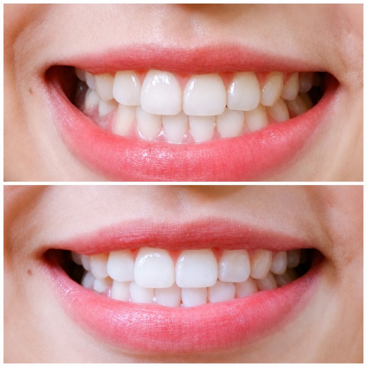Vorher-nachher-Ergebnis Zahnaufhellung bei Deezy Dental Home, sichtbar weißeres Lächeln
