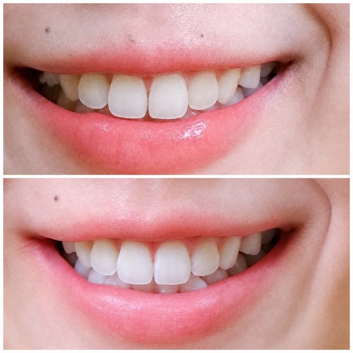 Vorher-nachher-Ergebnis Zahnaufhellung bei Deezy Dental Home – sichtbar weißeres Lächeln