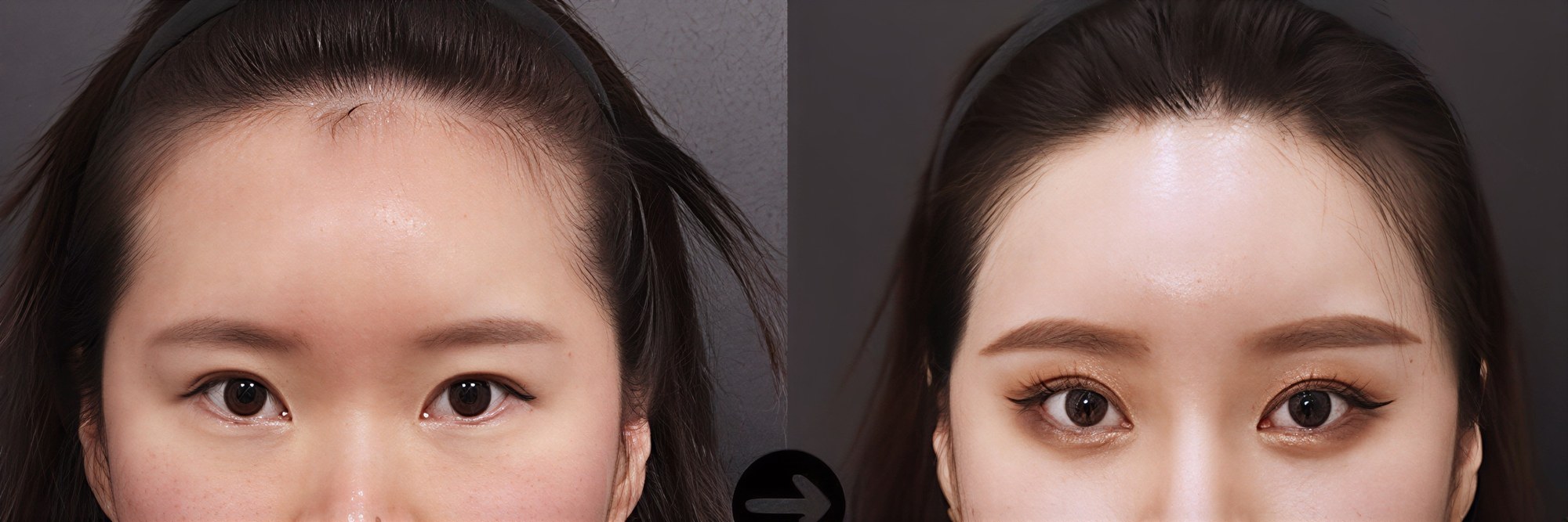 نتيجة شفط دهون الذقن قبل وبعد في VG Plastic Surgery – تحديد فك محسّن