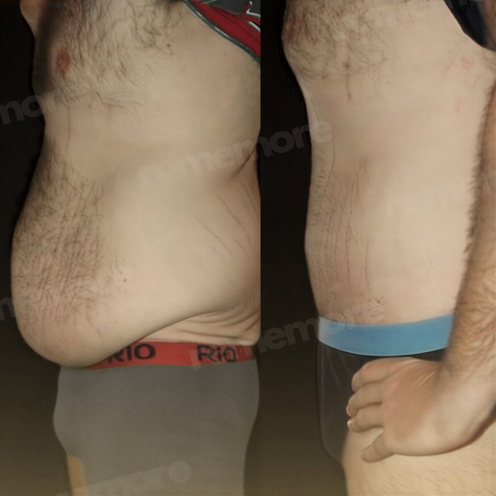 Resultados antes y después de Vaser liposucción en Memorial Antalya Hospital, abdomen mejorado