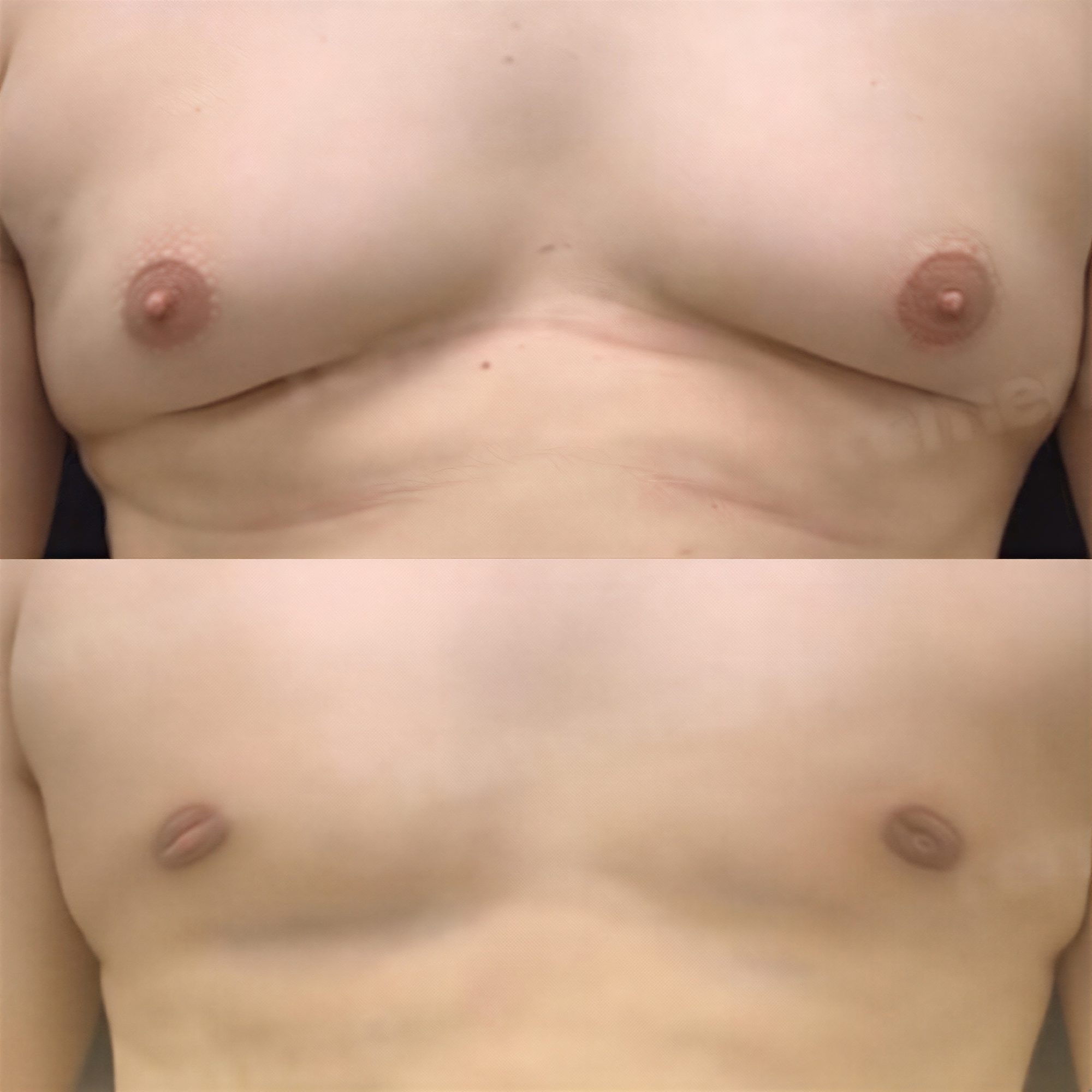 Resultados antes y después de liposucción Vaser en pecho masculino en Memorial Antalya Hospital