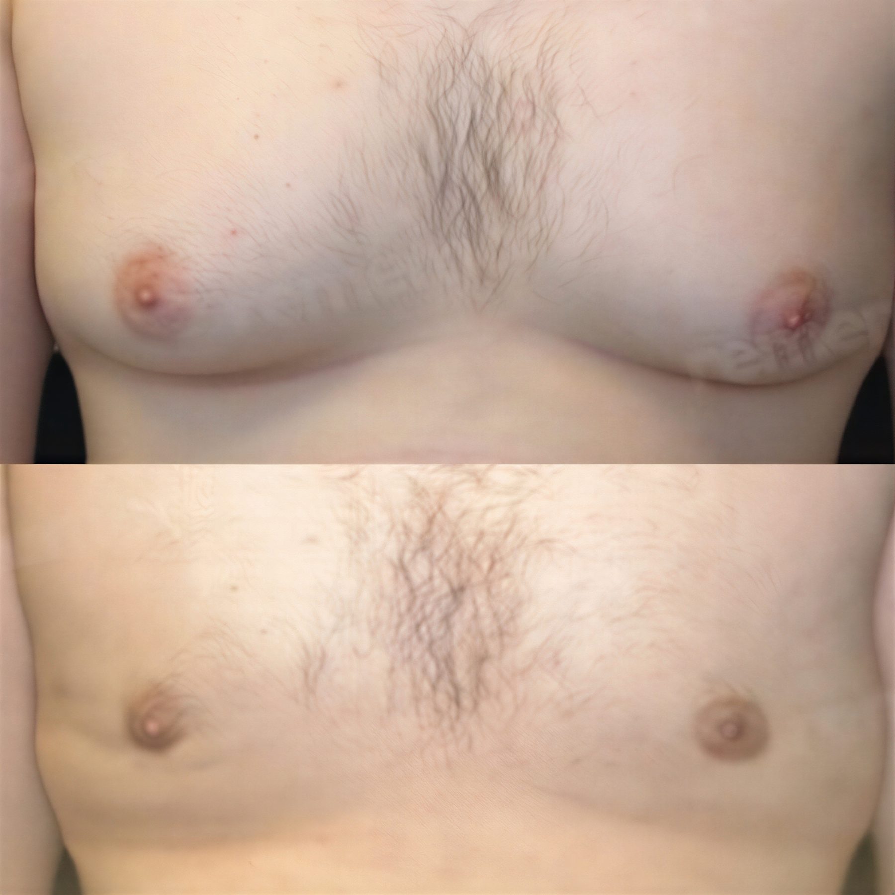 Resultados antes y después de liposucción Vaser en pecho masculino en Memorial Antalya Hospital