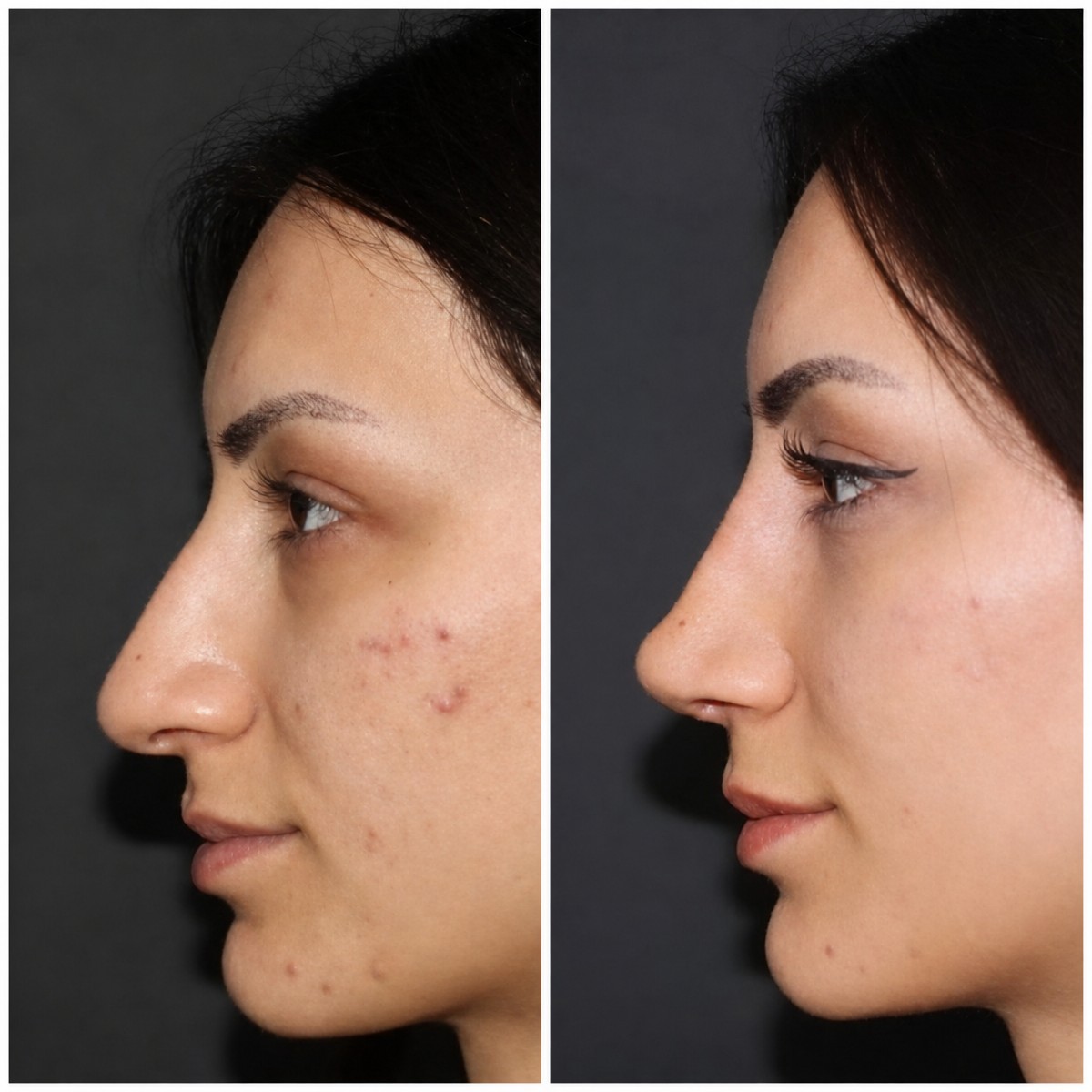 Before and after rhinoplasty results at TWT Health Clinic, nose reshaping for natural look