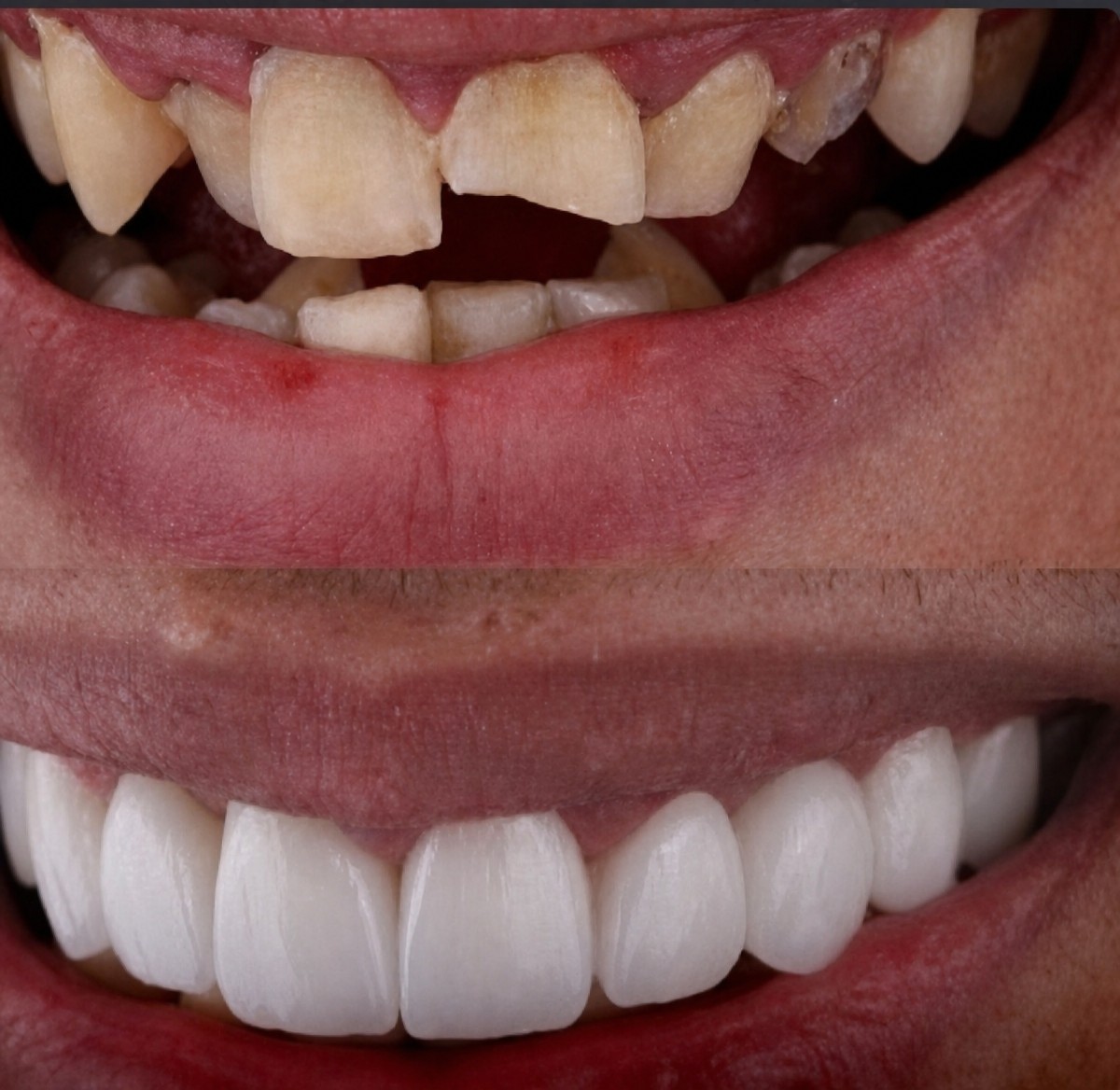 Resultados de Hollywood Smile antes y después en TWT Health Clinic – transformación con carillas
