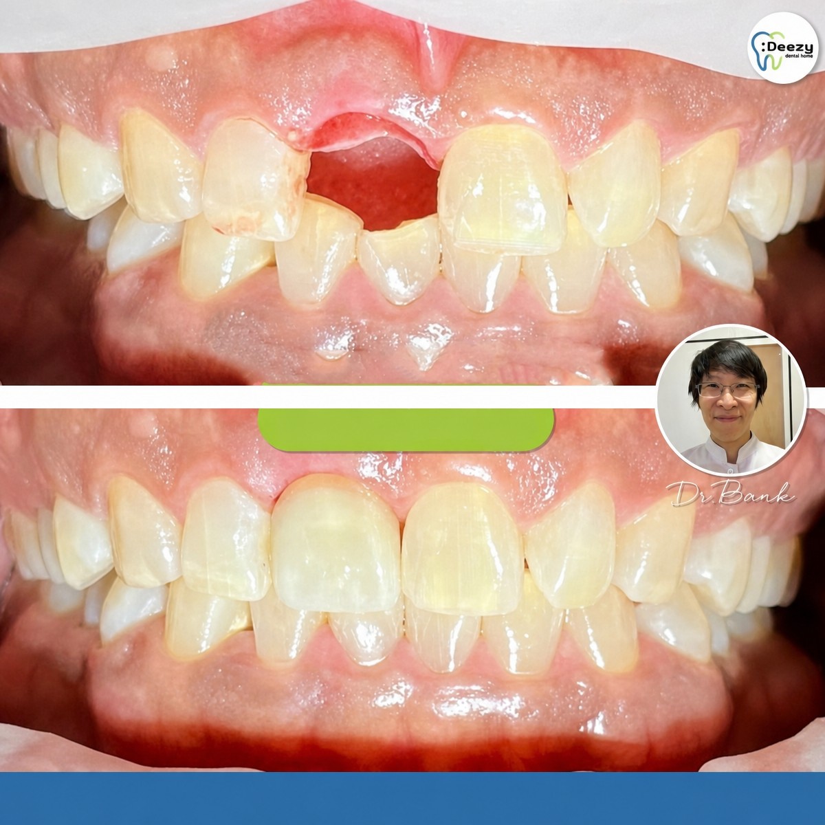 Resultados de implante dental antes y después en Deezy Dental Home: diente frontal restaurado