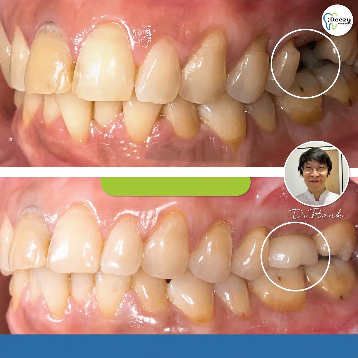 Resultados de implante dental antes y después en Deezy Dental Home, mejor alineación dental