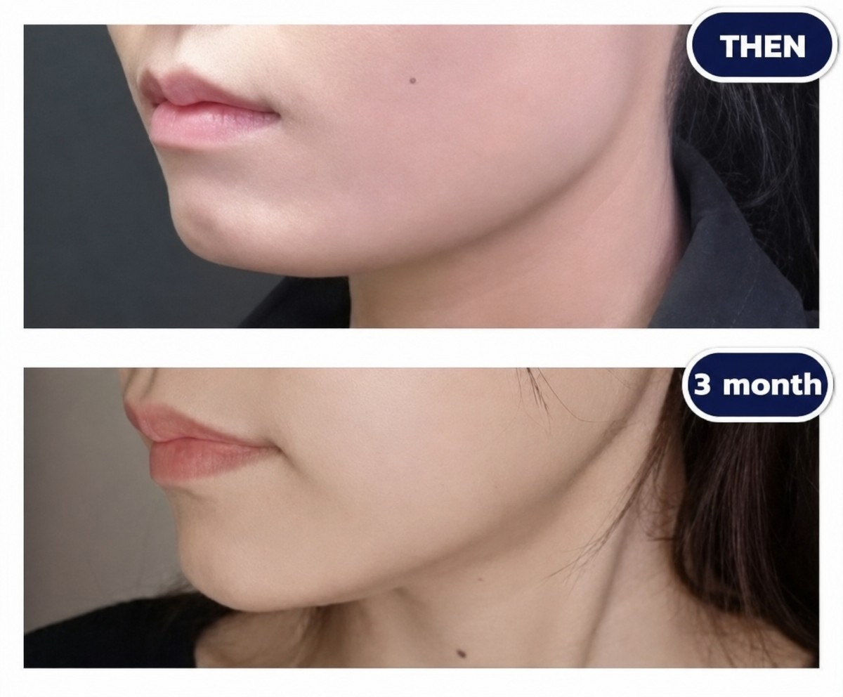 Before and after chin implant results at Asia Cosmetic Hospital, improved chin contour visible