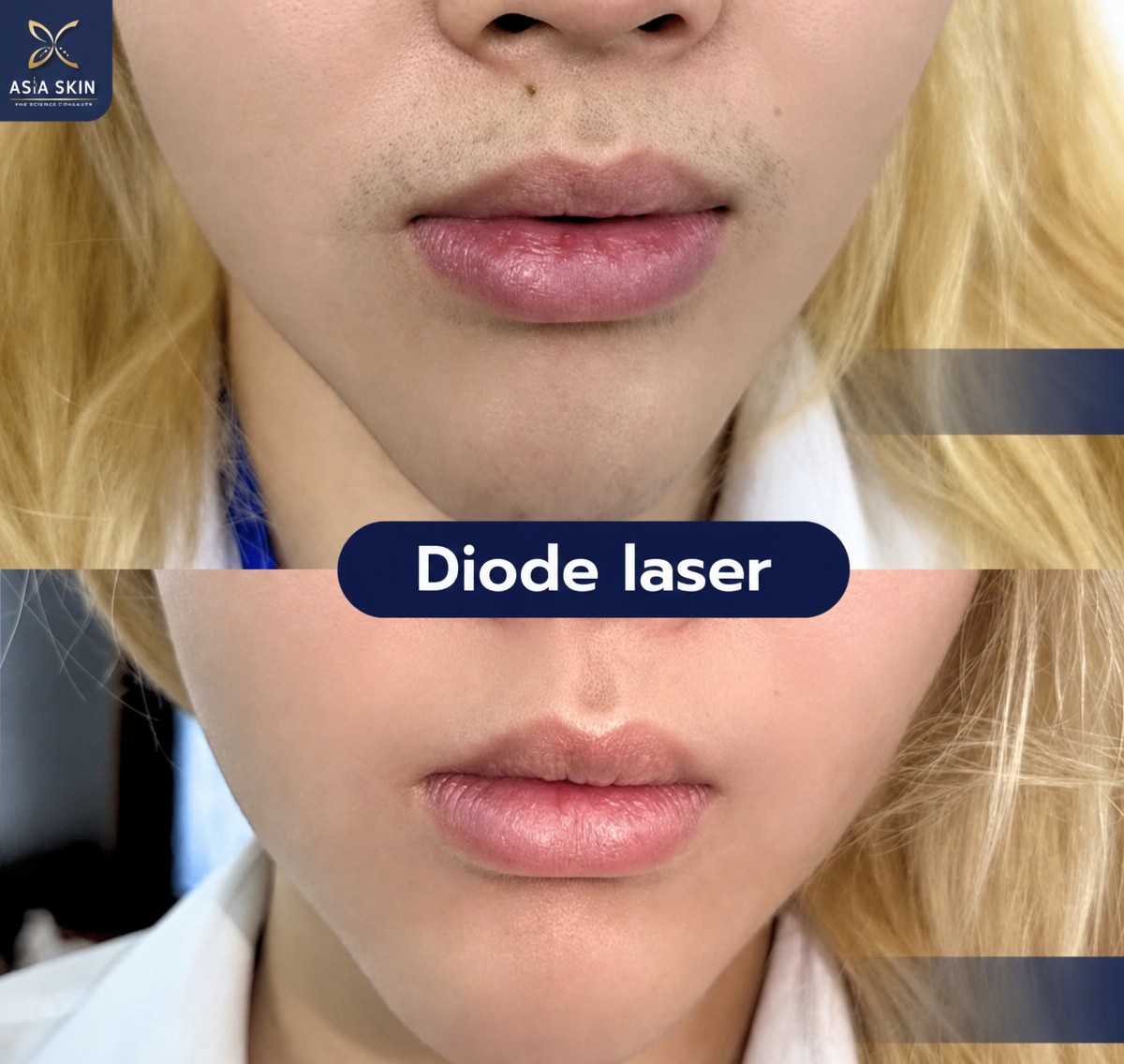 Résultats avant/après épilation laser diode à ASIA CLINIC, peau lisse sur la lèvre supérieure
