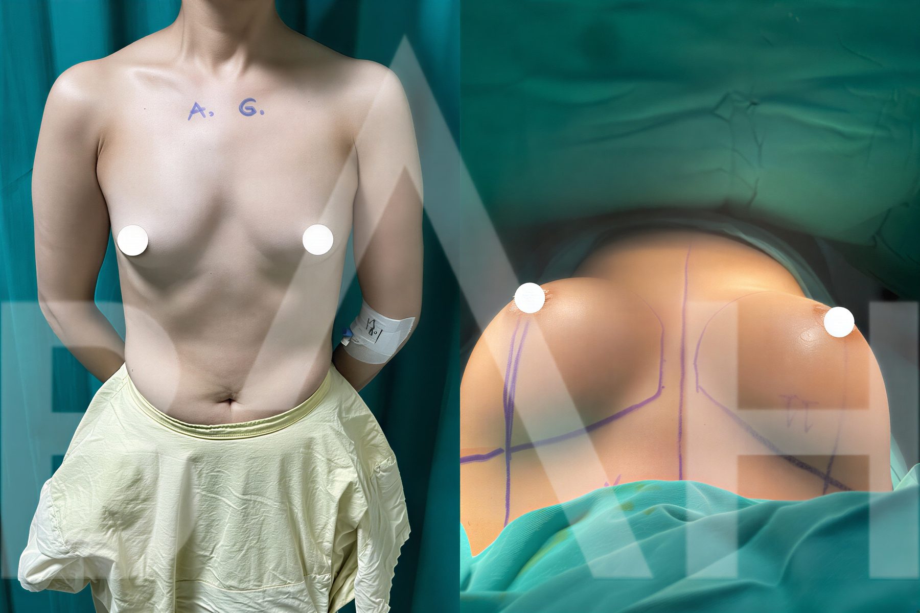 Resultados antes y después de implantes y levantamiento de senos en Büyük Anadolu Hospitals (BAH)