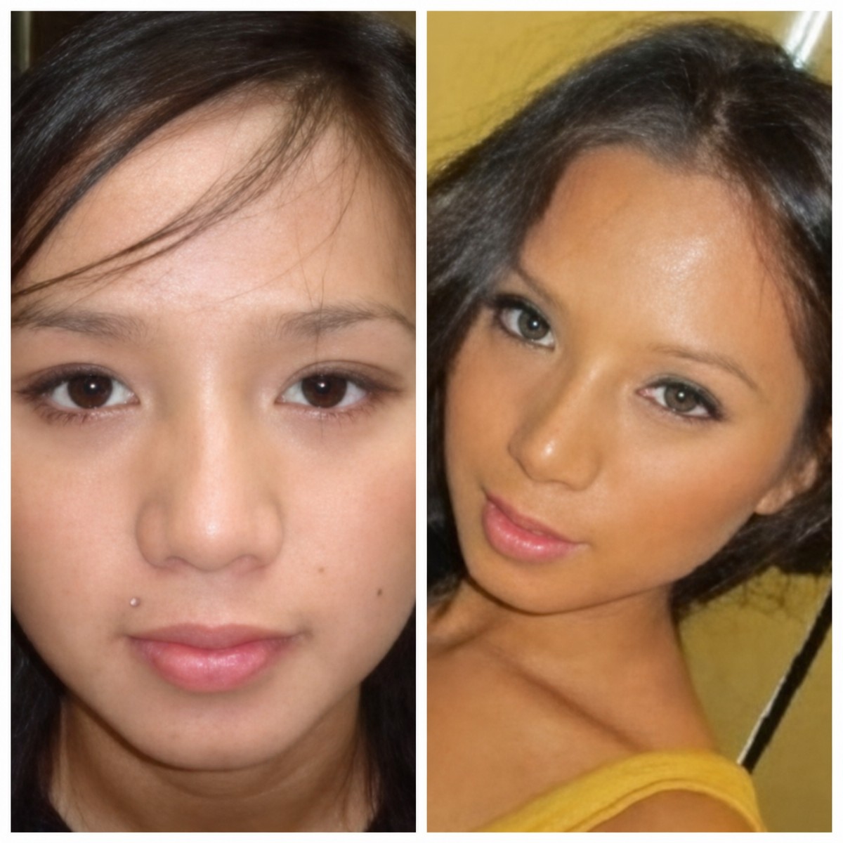 نتائج عملية تجميل الأنف قبل وبعد في Bangkok Plastic Surgery، تحسين شكل الأنف