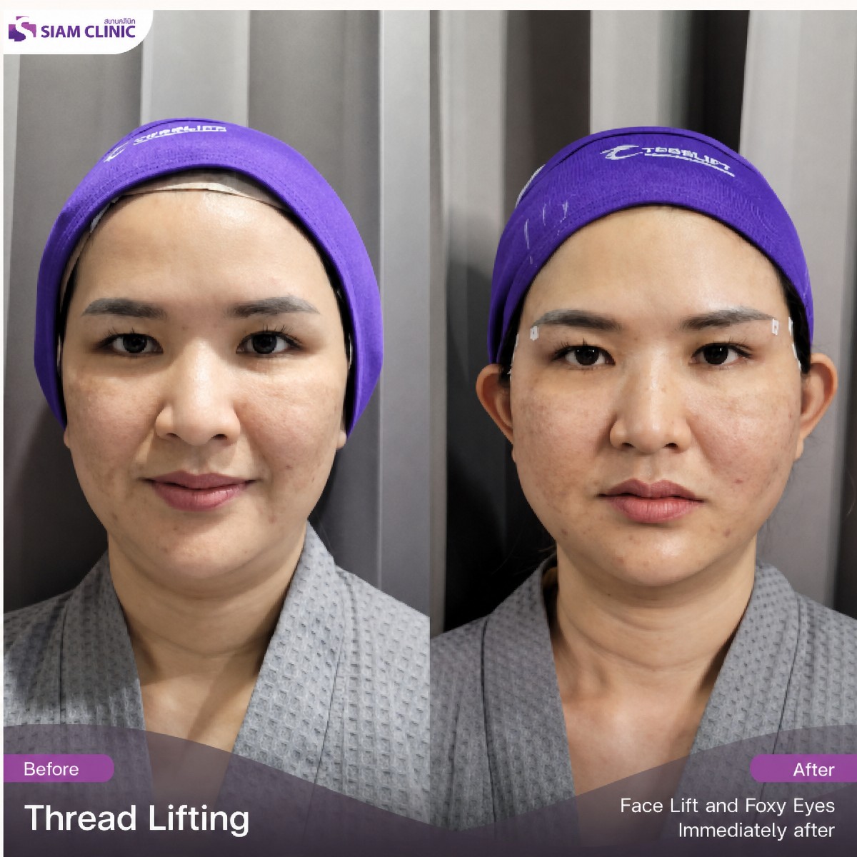 Before and after hyaluronic acid thread lifting results at Siam Clinic Phuket, facial contour lift