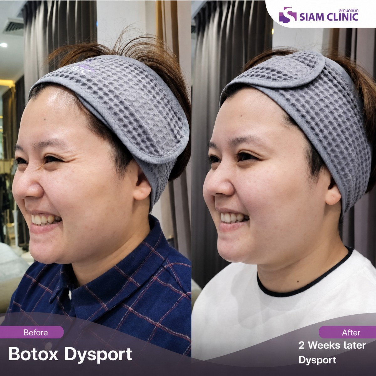 Résultats avant et après Botox Dysport pour rides du visage à Siam Clinic Phuket