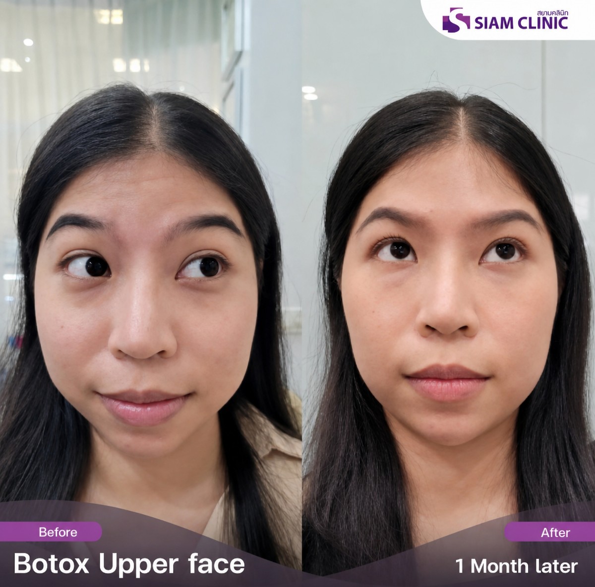 Resultados de botox en la frente antes y después en Siam Clinic Phuket, rostro más liso