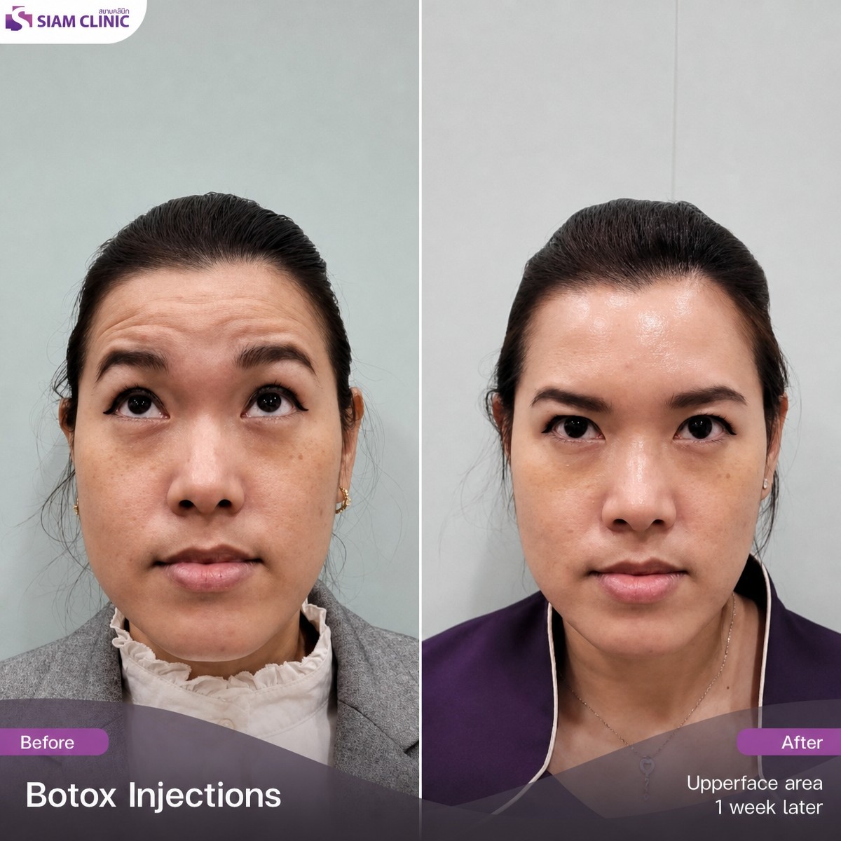 Antes y después de botox en la frente en Siam Clinic Phuket, resultado de frente más lisa