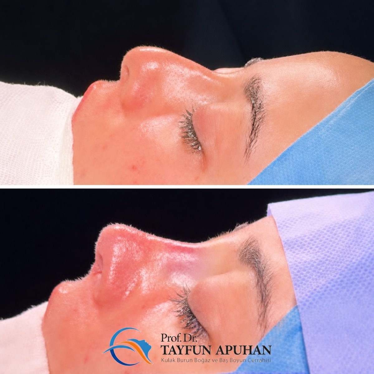 Before and after rhinoplasty results at Hisar Hospital Intercontinental, improved nose profile