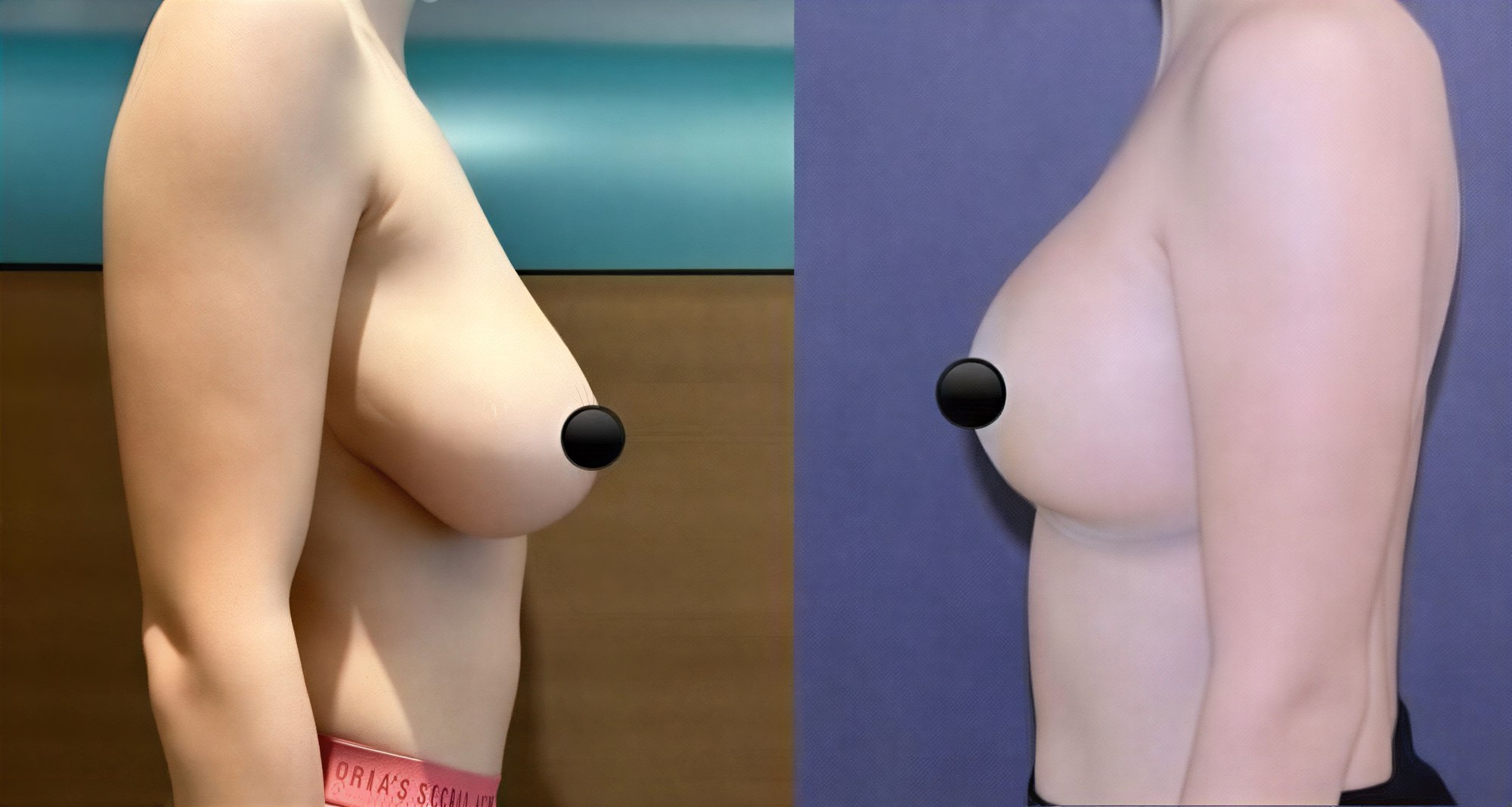 Resultados de lifting de senos antes y después en TWT Health Clinic, mejor contorno y firmeza