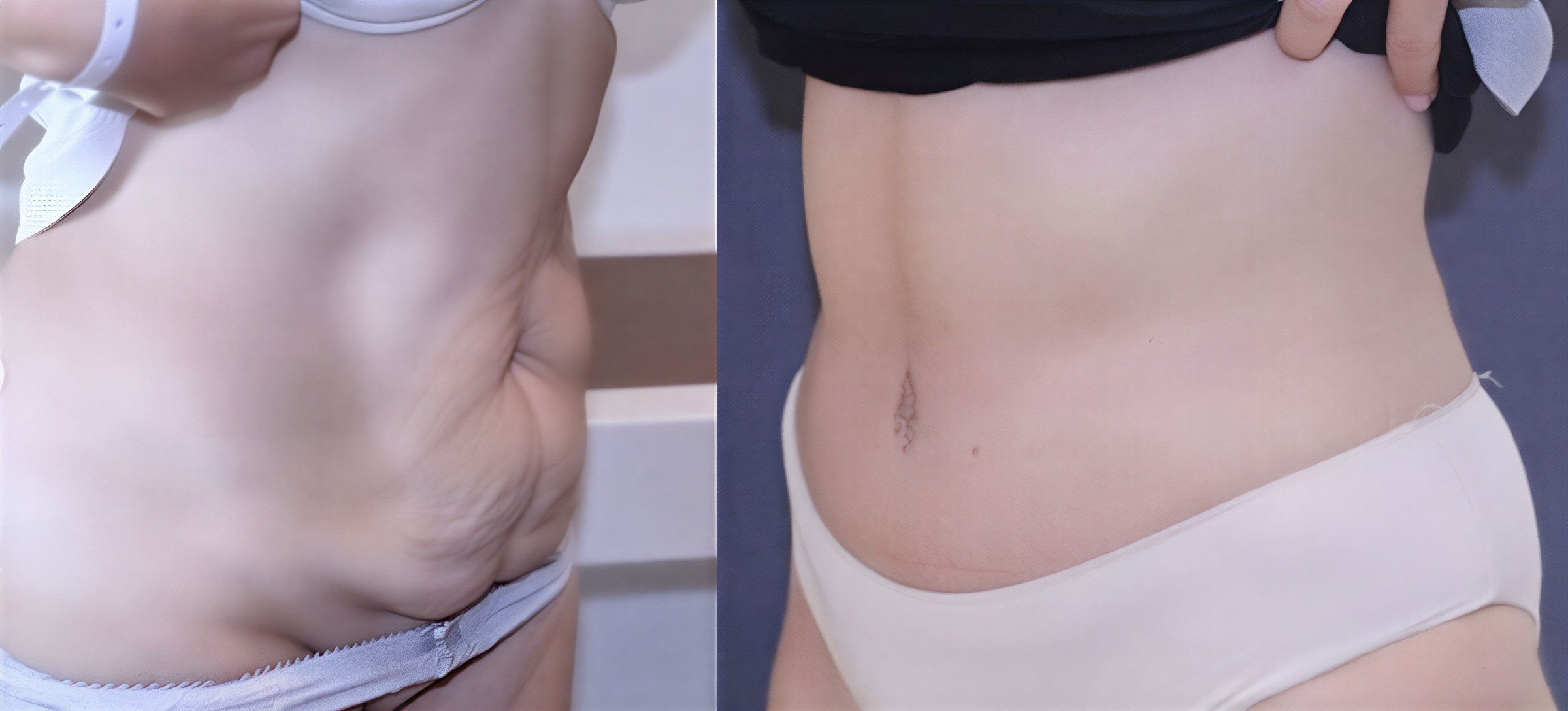 Resultados de abdominoplastia antes y después en TWT Health Clinic – abdomen más firme
