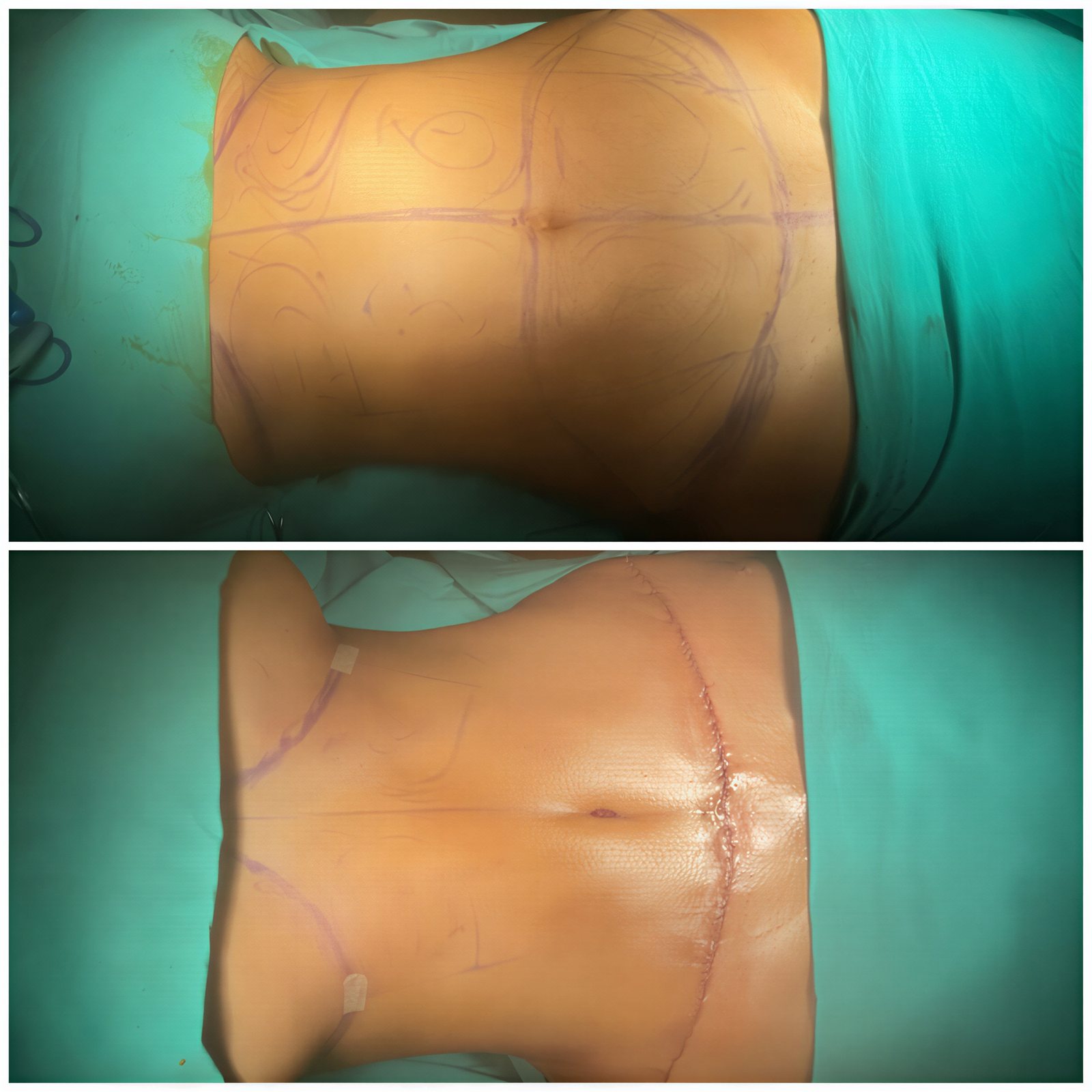 Resultados de abdominoplastia antes y después en TWT Health Clinic, mejor contorno abdominal