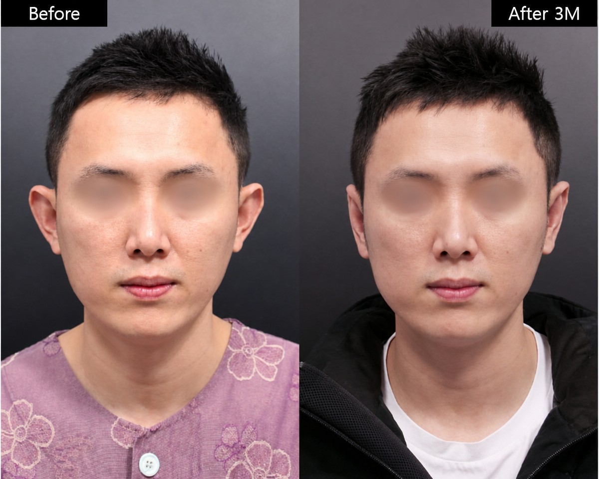 Результати отопластики до і після у VG Plastic Surgery, покращена форма та симетрія вух