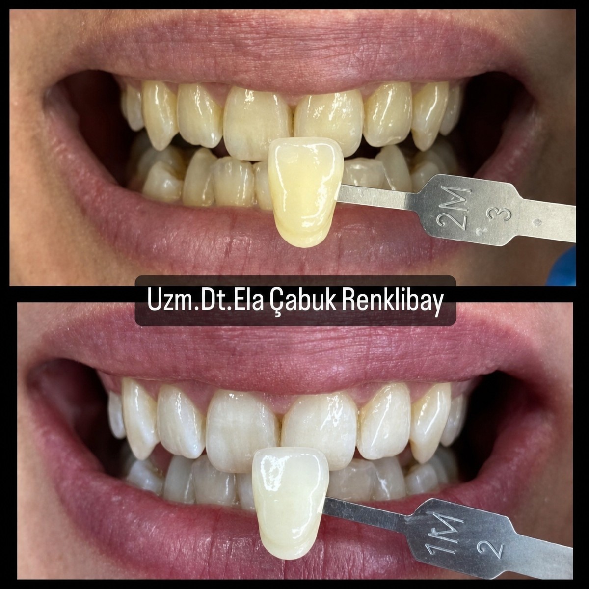 Resultados de blanqueamiento dental antes y después en la clínica de la Dra. Ela Cabuk Renklibay
