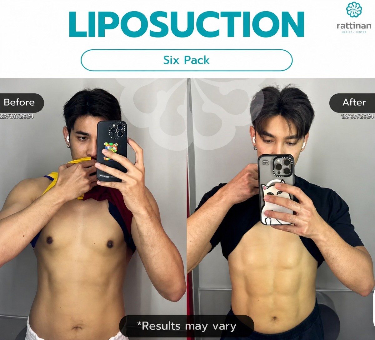Resultados antes y después de marcación abdominal (six pack) en Rattinan Clinic
