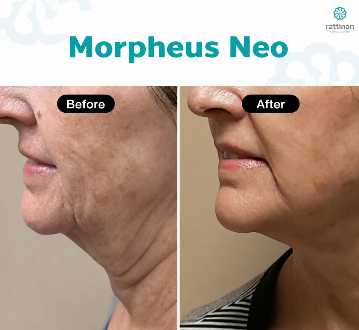 Before and after Morpheus8 skin tightening results at Rattinan Clinic, improved jawline contour
