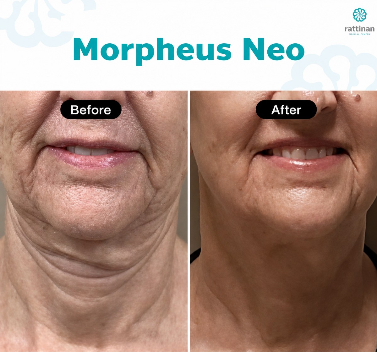 Before and after Morpheus8 skin tightening results at Rattinan Clinic, improved jawline