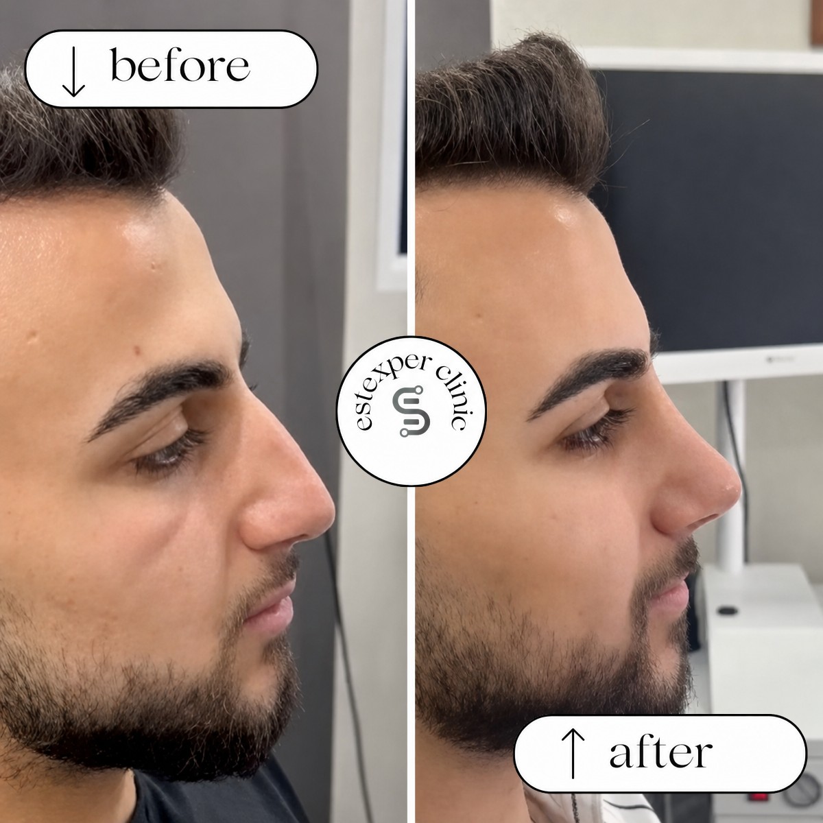 Before and after rhinoplasty result at Estexper Clinic, improved nose shape for male patient