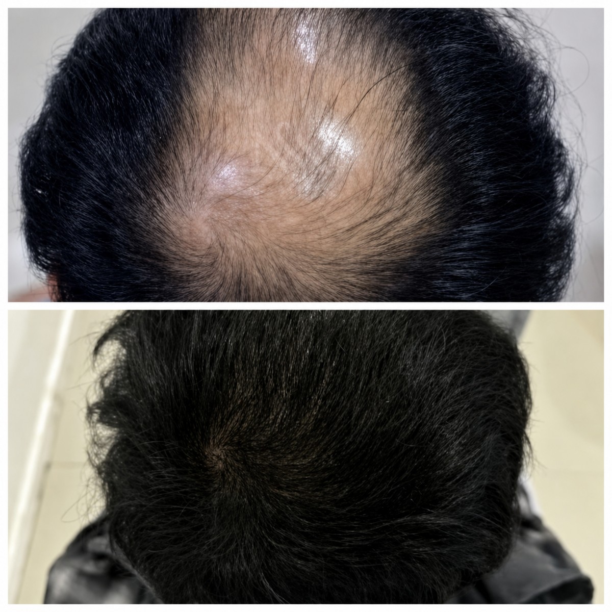 Resultados antes y después de trasplante capilar FUE en Namninforv Clinic, densidad restaurada